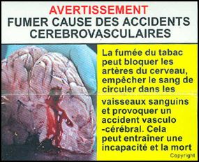 Djibouti 2009 Health Effects stroke - diseased organ, brain, stroke, gross - French